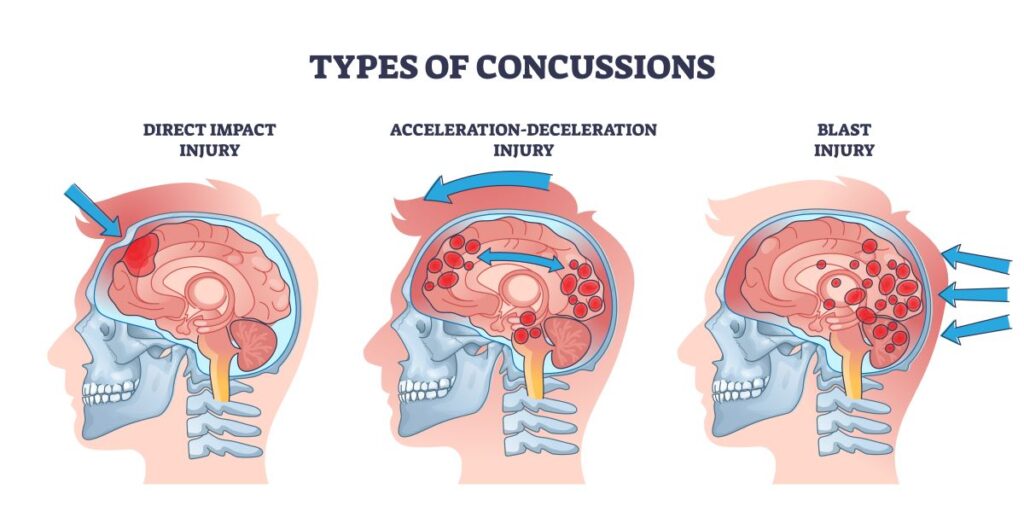 A medical illustration of the types of concussion.