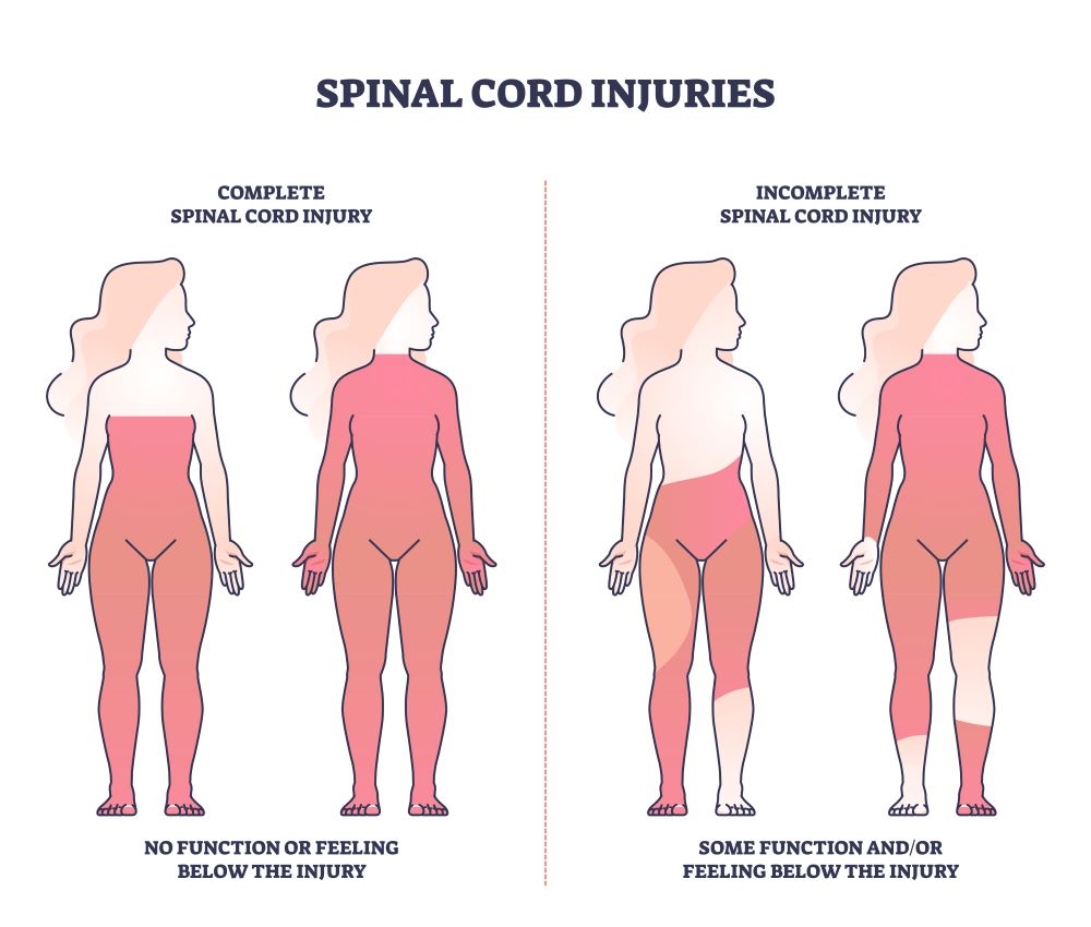 An illustrated chart of spinal cord injuries